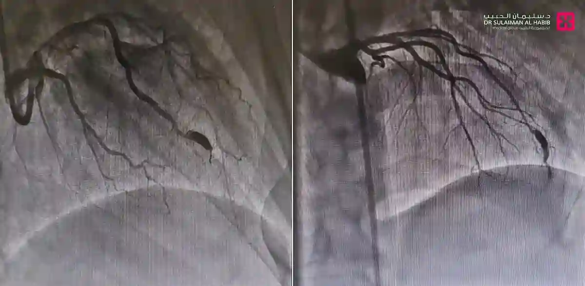 قسطرة القلب