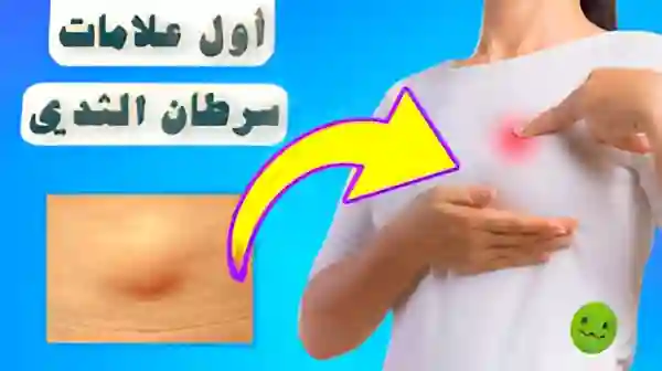 علامات تكشف سرطان الثدي مبكرًا