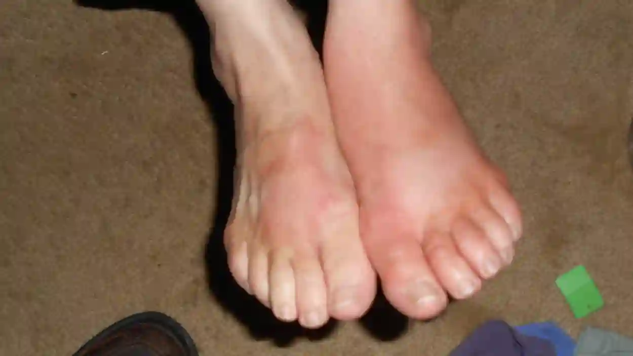 القدم السكرية