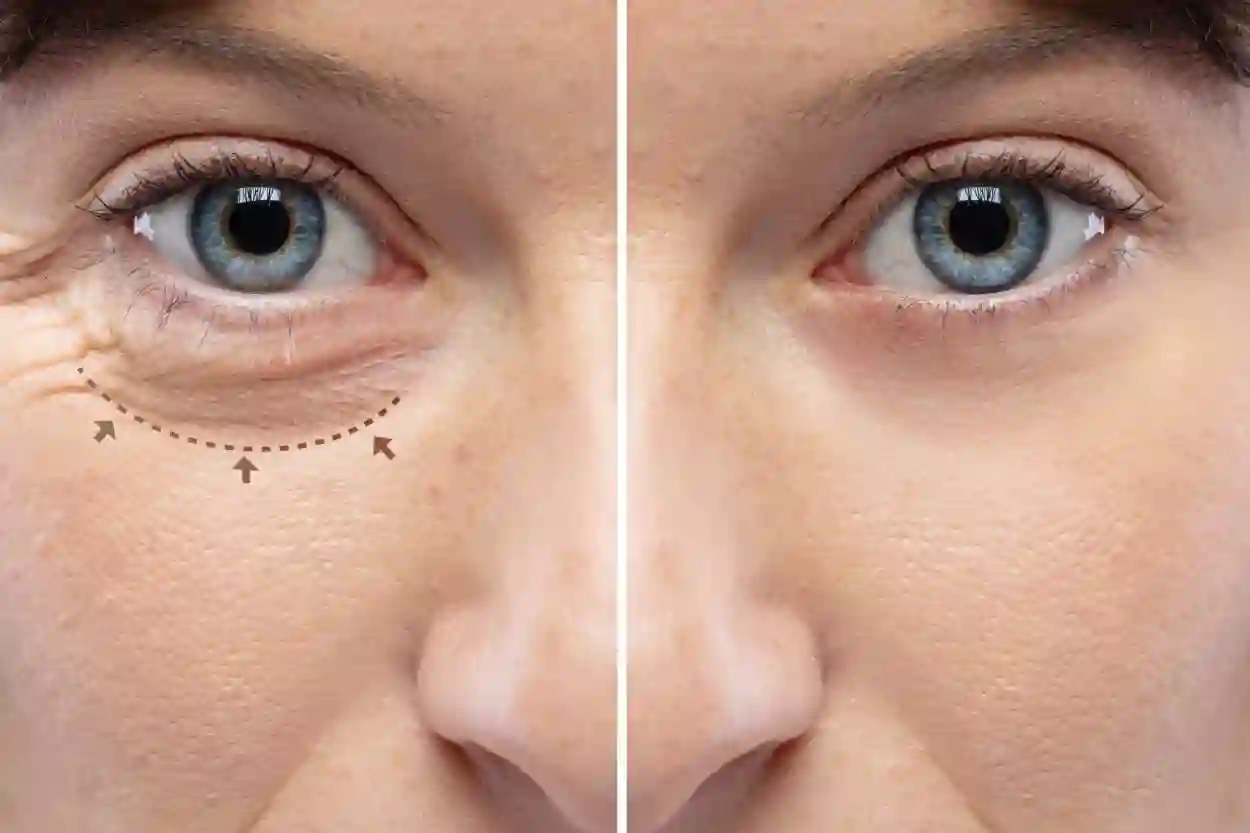 عمليات الجفون